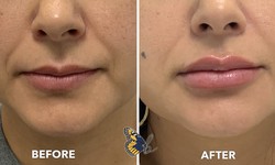 Why to Choose the best lip fillers Houston