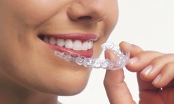 Clear Aligner Therapy: A Popular Alternative to Traditional Braces