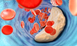 Sudden Increase in Cholesterol Levels: What Can Cause It?