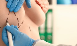 Your Complete Guide To Breast Explant Surgery