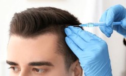 Combining PRP Hair Therapy with Other Hair Loss Treatments: Does It Improve Results?
