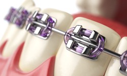 Early Orthodontic Care Avoids Costly Future Treatments