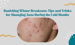 Banishing Winter Breakouts: Tips and Tricks for Managing Acne During the Cold Months