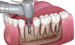 Root Canal Treatment Christchurch - A Clinical Intervention