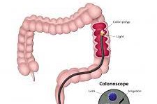 Colonoscopy: Why is it necessary to perform one?