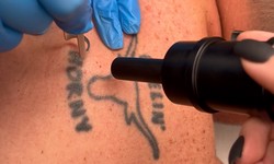 Say Goodbye to Your Tattoo with These Effective Removal Techniques