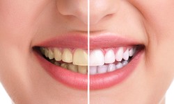 What Are The Cosmetic Dentistry Procedures To Enhance Your Teeth?