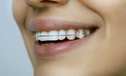 How Long You May Need To Wear A Retainer And Why