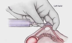 No-Scalpel Vasectomy: A Minimally Invasive Option for Permanent Male Contraception