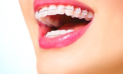 Ceramic Braces: Aesthetic, Comfortable, And Effective Orthodontic Treatment Option