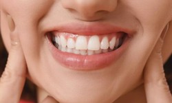 Gum Bleaching: Restoring Confidence in Your Smile