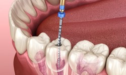Why Dentists Prefer Root Canal Treatment ?