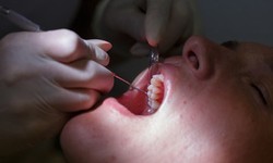 The BriteGums Procedure: A Brighter Smile and Enhanced Oral Health