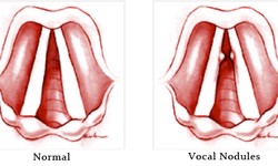 Vocal Nodules: Symptoms, Causes, and Treatment Options