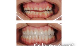 Dentists Richmond for Teeth Whitening
