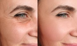 Botox Injections: A Non-Surgical Approach to Wrinkle Reduction