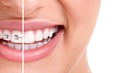 Smile with Confidence: The Advantages of Dental Braces for Adults