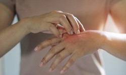 The Best Ways to Treat Hand Eczema, According To Dermatologists