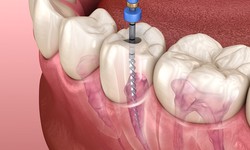 Root Canal Treatment in Lahore: Restoring Oral Health and Relieving Dental Pain