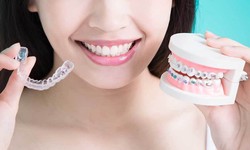 How Long Should You Wear The Retainer After Invisalign?