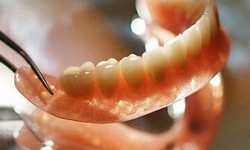Fixing Dentures: Bringing Smiles Back with Precision and Care