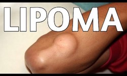 Natural Remedies for Lipoma Treatment at Home
