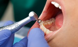 Dental Treatment Services in Ahmedabad