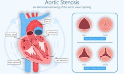Aortic Surgery and its benefits