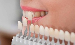 Porcelain Veneers: Elegance and Perfection in a Smile