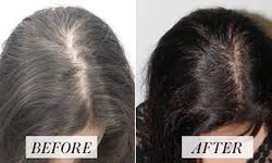 Hair Loss Beware! Discover the Magic of Hair Transplantation in Andheri West