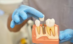 Dental Crowns: A Comprehensive Guide to Treatment, Benefits, and Care
