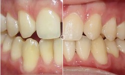 Why Teeth Straightening Will be a Great Decision to Go For?
