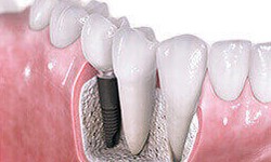 What Are The Considerations When Choosing Dental Crown Material?