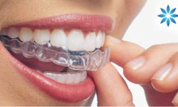 Want to align teeth with discretion? Know what to expect from the Invisalign journey