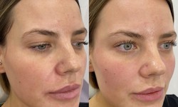 Discover the Magic of Dermal Fillers in Camberwell: Enhance Your Natural Beauty