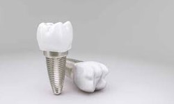 The Complete Guide to Dental Implants: What You Need to Know in Leeds