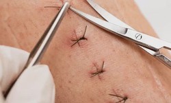 Suture Removal Made Simple: Your Home Recovery Companion