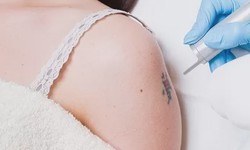 Vanish Your Tattoos with the Best Removal Clinic Ultimate Guide