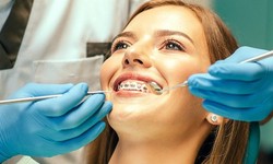 "Unlocking Your Best Smile: A Comprehensive Guide to Dental Braces"