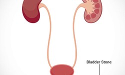 What All You Need To Know About Bladder Stone Removal Surgery