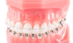 How to discover the Benefits of Invisalign Treatment in Garland?