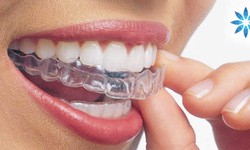 How to Clean and Care for Your Invisalign Aligners