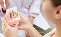 Importance Of Dental Care After 30