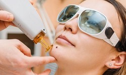 Laser Mole Removal: A Painless and Effective Solution