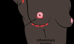 Is Inverted Nipple Correction Surgery Right for You: Learn More?