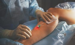 Unlocking the Potential of Vein Treatment: Your Comprehensive Guide