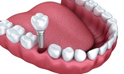 Dental Implants: Your Path to a Confident Smile in NE Calgary