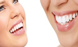 5 Most Definite Reasons for Teeth Whitening to Be One of the Most Popular Treatments