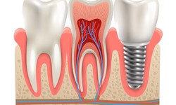 Frequently Asked Questions (FAQs) about Dental Implants, Dental Crowns, and Root Canals