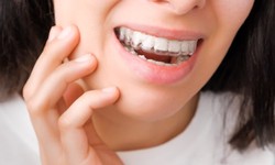 The Unseen Benefits: Advantages of Invisible Braces
